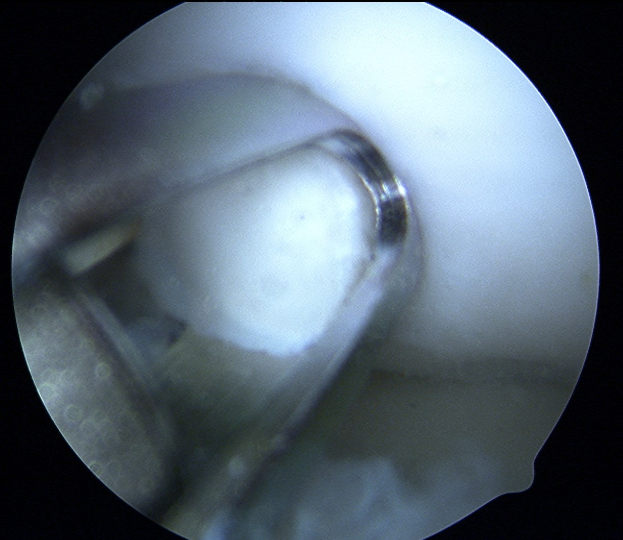 Mosaicplasty Cartilage Cap Proud